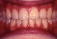 tannregulering_etter